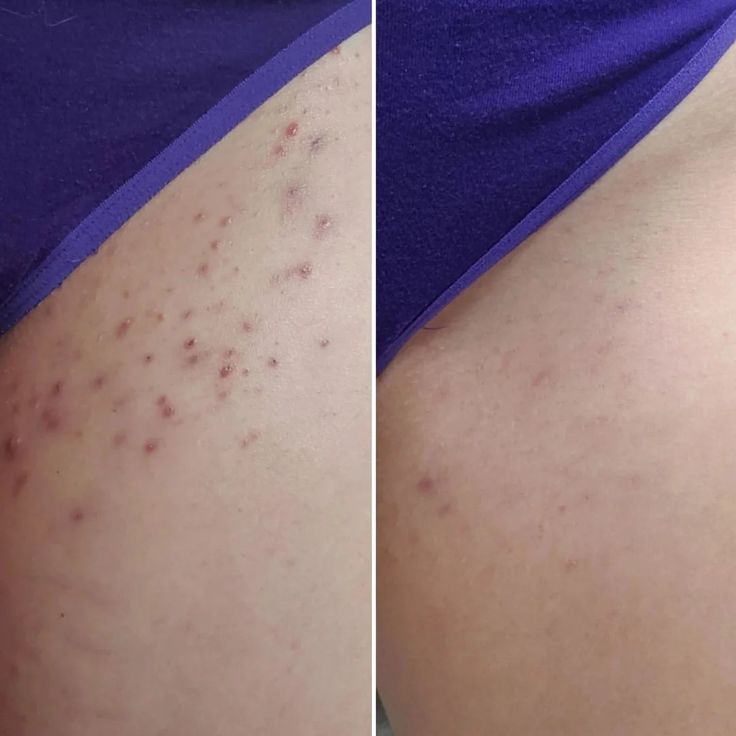 Resultaat laserontharing Bikinilijn, voor en na