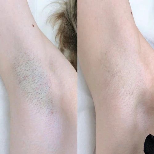 Resultaat laserontharing Oksels, voor en na