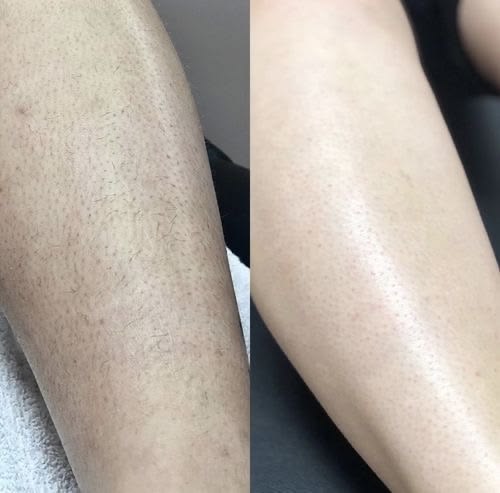 Resultaat laserontharing Onderbeen, voor en na